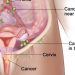 World Cancer Day: Female students advised to abstain from smoking, keep one partner to avoid Cervical Cancer
